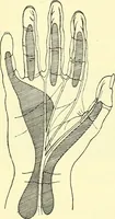 An illustration from Modern surgery, general and operative / by John Chalmers Da Costa. (1907)