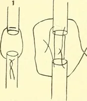 Picture 226 of 481 from Modern surgery, general and operative / by John Chalmers Da Costa. (1907), leaf 674