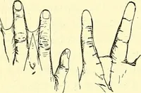 Picture 229 of 481 from Modern surgery, general and operative / by John Chalmers Da Costa. (1907), leaf 678