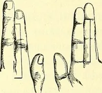 An illustration from Modern surgery, general and operative / by John Chalmers Da Costa. (1907)