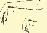 An illustration from Modern surgery, general and operative / by John Chalmers Da Costa. (1907)