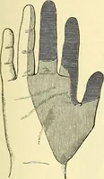 Picture 235 of 481 from Modern surgery, general and operative / by John Chalmers Da Costa. (1907), leaf 689