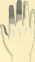 Picture 236 of 481 from Modern surgery, general and operative / by John Chalmers Da Costa. (1907), leaf 689