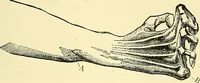 An illustration from Modern surgery, general and operative / by John Chalmers Da Costa. (1907)