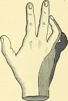 Picture 240 of 481 from Modern surgery, general and operative / by John Chalmers Da Costa. (1907), leaf 691