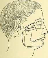 An illustration from Modern surgery, general and operative / by John Chalmers Da Costa. (1907)
