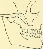 An illustration from Modern surgery, general and operative / by John Chalmers Da Costa. (1907)