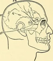 Picture 251 of 481 from Modern surgery, general and operative / by John Chalmers Da Costa. (1907), leaf 707