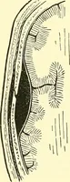 An illustration from Modern surgery, general and operative / by John Chalmers Da Costa. (1907)