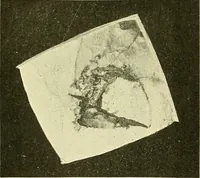 Picture 256 of 481 from Modern surgery, general and operative / by John Chalmers Da Costa. (1907), leaf 725