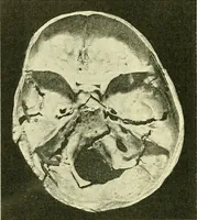 An illustration from Modern surgery, general and operative / by John Chalmers Da Costa. (1907)