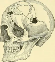 Picture 258 of 481 from Modern surgery, general and operative / by John Chalmers Da Costa. (1907), leaf 729