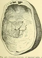 Picture 259 of 481 from Modern surgery, general and operative / by John Chalmers Da Costa. (1907), leaf 729