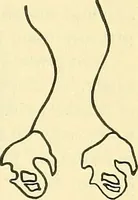 Picture 264 of 481 from Modern surgery, general and operative / by John Chalmers Da Costa. (1907), leaf 765