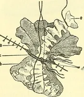 Picture 32 of 481 from Modern surgery, general and operative / by John Chalmers Da Costa. (1907), leaf 78