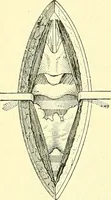 An illustration from Modern surgery, general and operative / by John Chalmers Da Costa. (1907)
