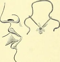 An illustration from Modern surgery, general and operative / by John Chalmers Da Costa. (1907)