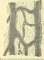 Picture 34 of 481 from Modern surgery, general and operative / by John Chalmers Da Costa. (1907), leaf 81