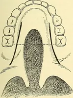 Picture 276 of 481 from Modern surgery, general and operative / by John Chalmers Da Costa. (1907), leaf 811