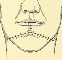 Picture 280 of 481 from Modern surgery, general and operative / by John Chalmers Da Costa. (1907), leaf 815