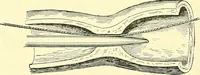Picture 281 of 481 from Modern surgery, general and operative / by John Chalmers Da Costa. (1907), leaf 822