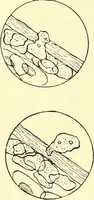 Picture 37 of 481 from Modern surgery, general and operative / by John Chalmers Da Costa. (1907), leaf 84