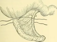 An illustration from Modern surgery, general and operative / by John Chalmers Da Costa. (1907)