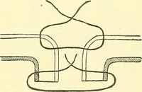 Picture 289 of 481 from Modern surgery, general and operative / by John Chalmers Da Costa. (1907), leaf 940