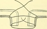 Picture 290 of 481 from Modern surgery, general and operative / by John Chalmers Da Costa. (1907), leaf 940