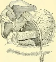 Picture 304 of 481 from Modern surgery, general and operative / by John Chalmers Da Costa. (1907), leaf 950