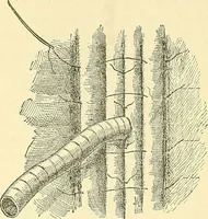 Picture 305 of 481 from Modern surgery, general and operative / by John Chalmers Da Costa. (1907), leaf 953