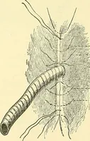 Picture 306 of 481 from Modern surgery, general and operative / by John Chalmers Da Costa. (1907), leaf 953