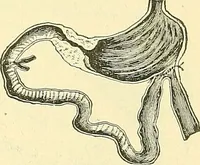 Picture 310 of 481 from Modern surgery, general and operative / by John Chalmers Da Costa. (1907), leaf 957