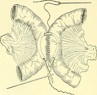Picture 312 of 481 from Modern surgery, general and operative / by John Chalmers Da Costa. (1907), leaf 960