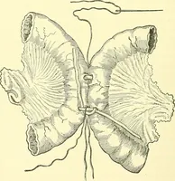 Picture 313 of 481 from Modern surgery, general and operative / by John Chalmers Da Costa. (1907), leaf 960