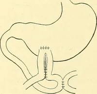 Picture 316 of 481 from Modern surgery, general and operative / by John Chalmers Da Costa. (1907), leaf 961