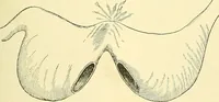 Picture 318 of 481 from Modern surgery, general and operative / by John Chalmers Da Costa. (1907), leaf 963