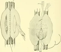 Picture 320 of 481 from Modern surgery, general and operative / by John Chalmers Da Costa. (1907), leaf 966