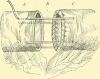 Picture 325 of 481 from Modern surgery, general and operative / by John Chalmers Da Costa. (1907), leaf 974