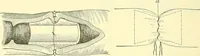 An illustration from Modern surgery, general and operative / by John Chalmers Da Costa. (1907)