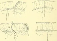 Picture 330 of 481 from Modern surgery, general and operative / by John Chalmers Da Costa. (1907), leaf 976