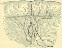 Picture 331 of 481 from Modern surgery, general and operative / by John Chalmers Da Costa. (1907), leaf 977