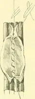 Picture 333 of 481 from Modern surgery, general and operative / by John Chalmers Da Costa. (1907), leaf 978