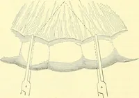 An illustration from Modern surgery, general and operative / by John Chalmers Da Costa. (1907)