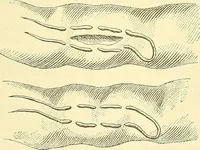 Picture 339 of 481 from Modern surgery, general and operative / by John Chalmers Da Costa. (1907), leaf 981