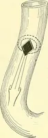 Picture 343 of 481 from Modern surgery, general and operative / by John Chalmers Da Costa. (1907), leaf 984