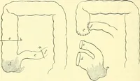 Picture 345 of 481 from Modern surgery, general and operative / by John Chalmers Da Costa. (1907), leaf 986