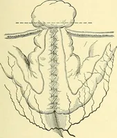 Picture 346 of 481 from Modern surgery, general and operative / by John Chalmers Da Costa. (1907), leaf 991