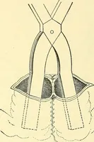 Picture 347 of 481 from Modern surgery, general and operative / by John Chalmers Da Costa. (1907), leaf 991