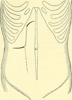 Picture 348 of 481 from Modern surgery, general and operative / by John Chalmers Da Costa. (1907), leaf 992